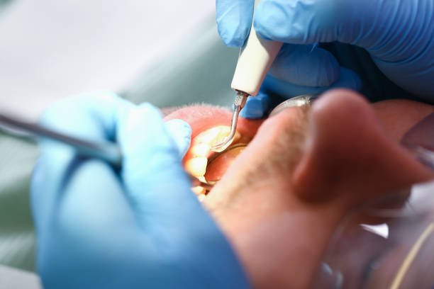 Best Emergency Dental Care for Broken or Chipped Teeth in Fort Sumner, NM